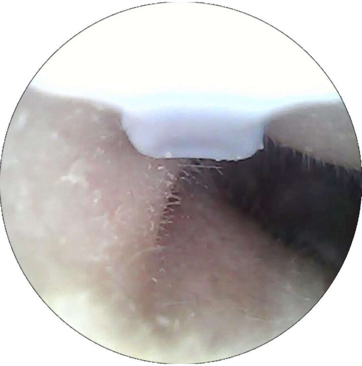 Kamerabild Ohrenschmalz-Entferner